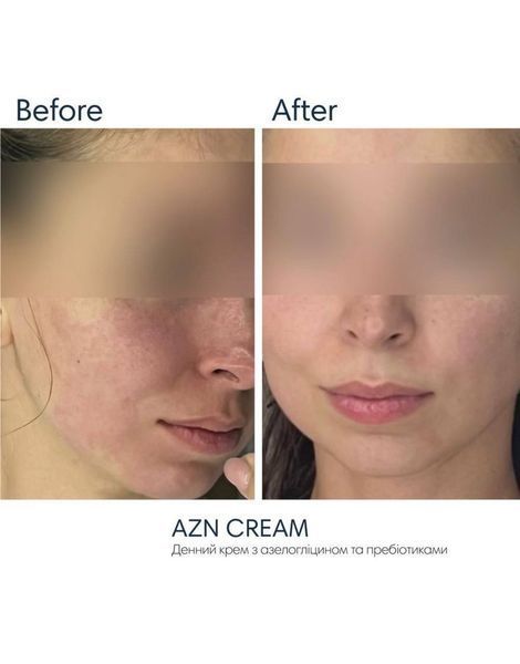 Сонцезахисний крем з протизапальним ефектом Braderm Azn Cream 30 ml 00-00000387 фото